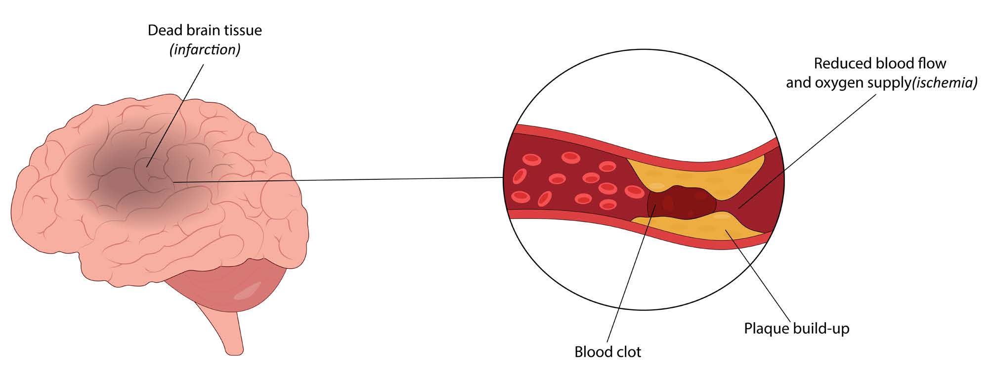 Graphic of Ischemic Stroke